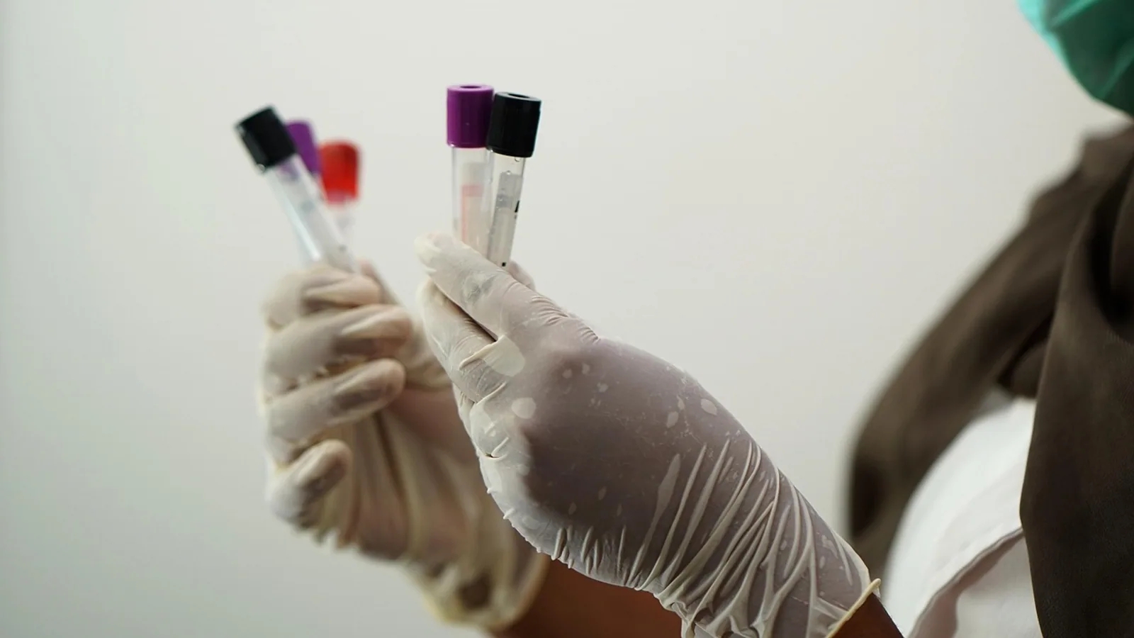 T Pallidum Antibody: Test Interpretation Guide