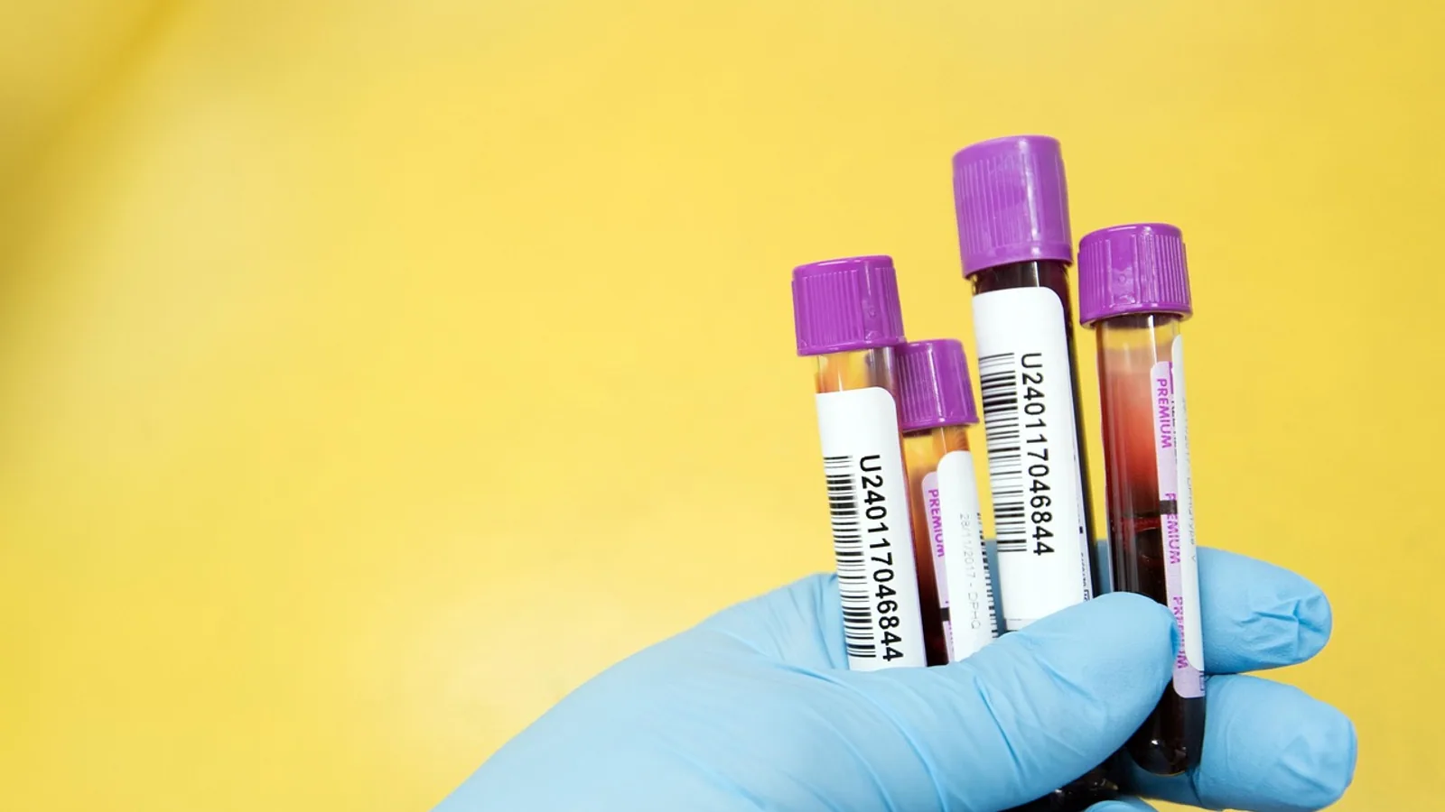 Alkaline Phosphatase Blood Test Explained