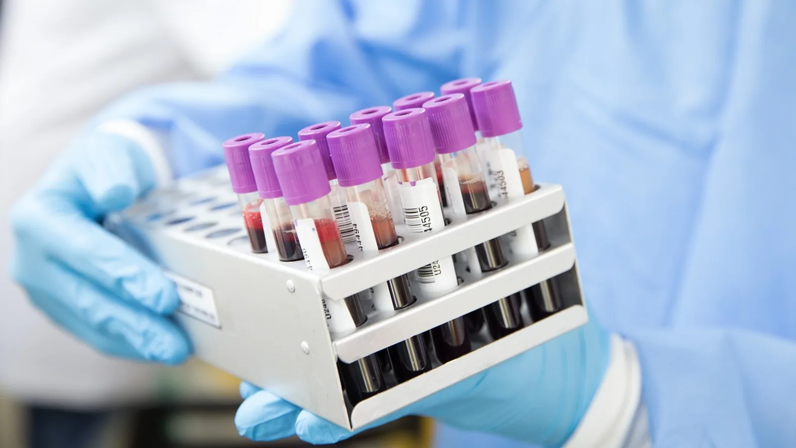 DIC Coagulopathy: Pathogenesis and Lab Findings