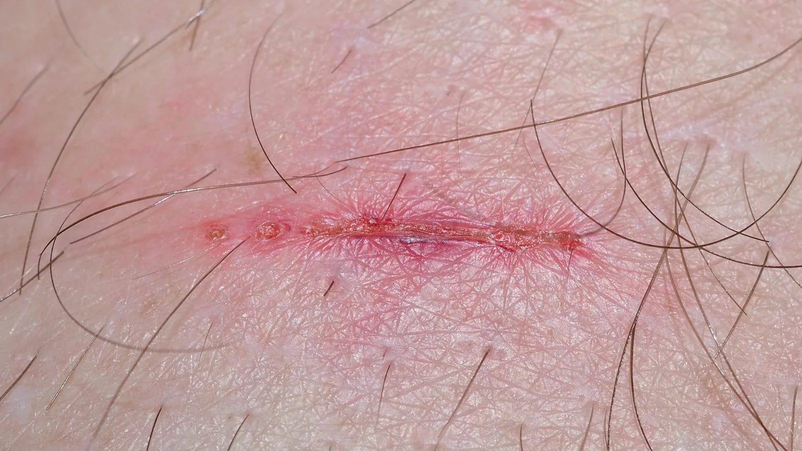 Rule of 9 Burns: Body Surface Area Estimation