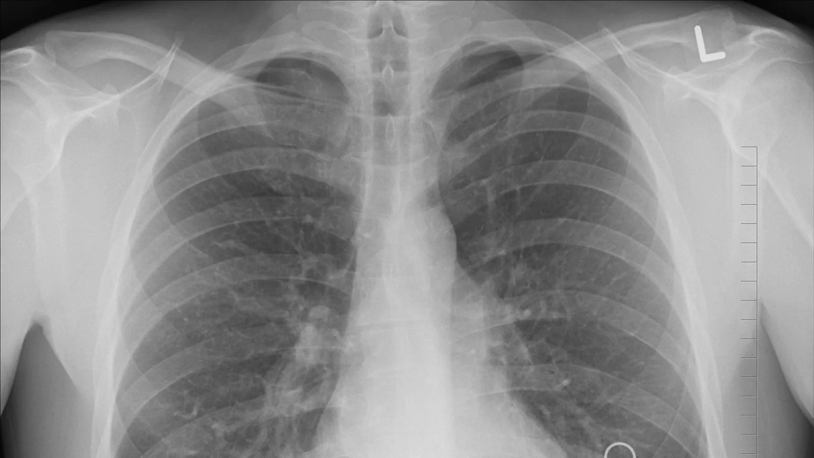 Rib Anatomy: Features, Landmarks, and Labeling