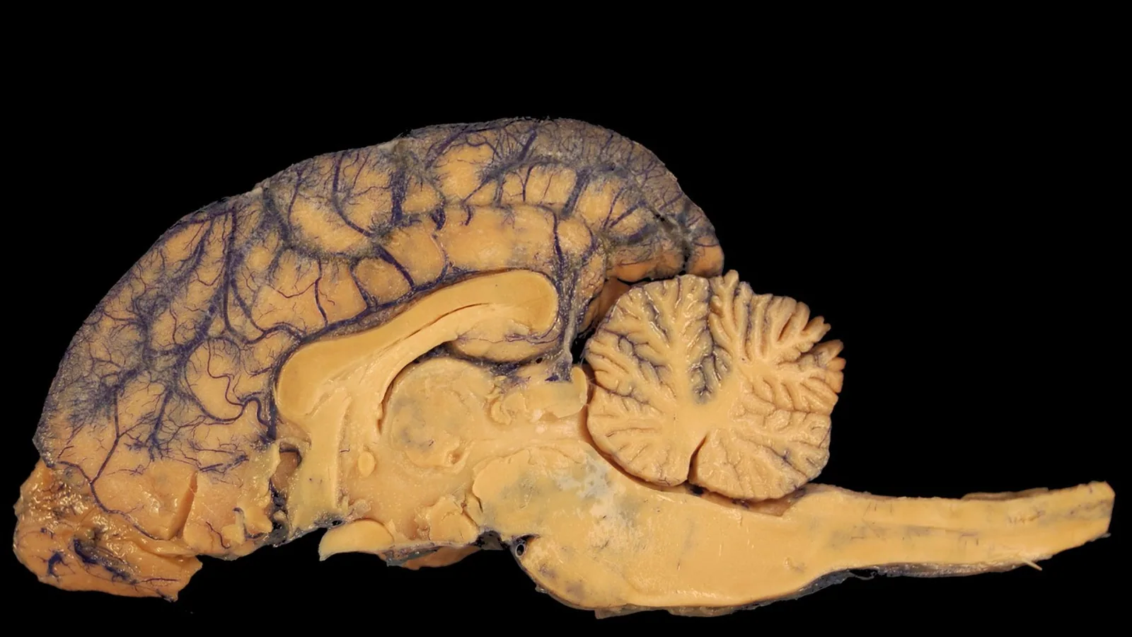 Choroid Plexuses: Location, Structure, and CSF Function