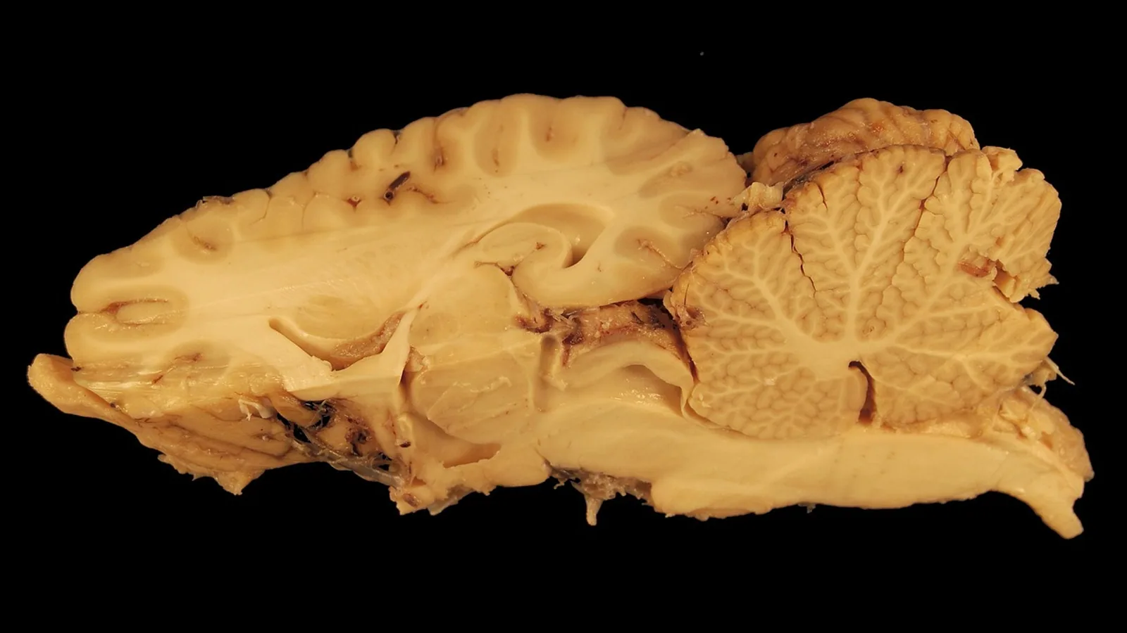 Brain Ventricles: Anatomy and Function of the Ventricular System