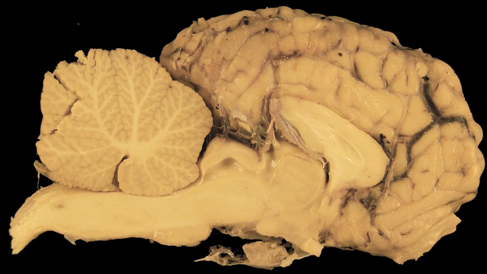 Mammillary Body: Location, Function, and Anatomy
