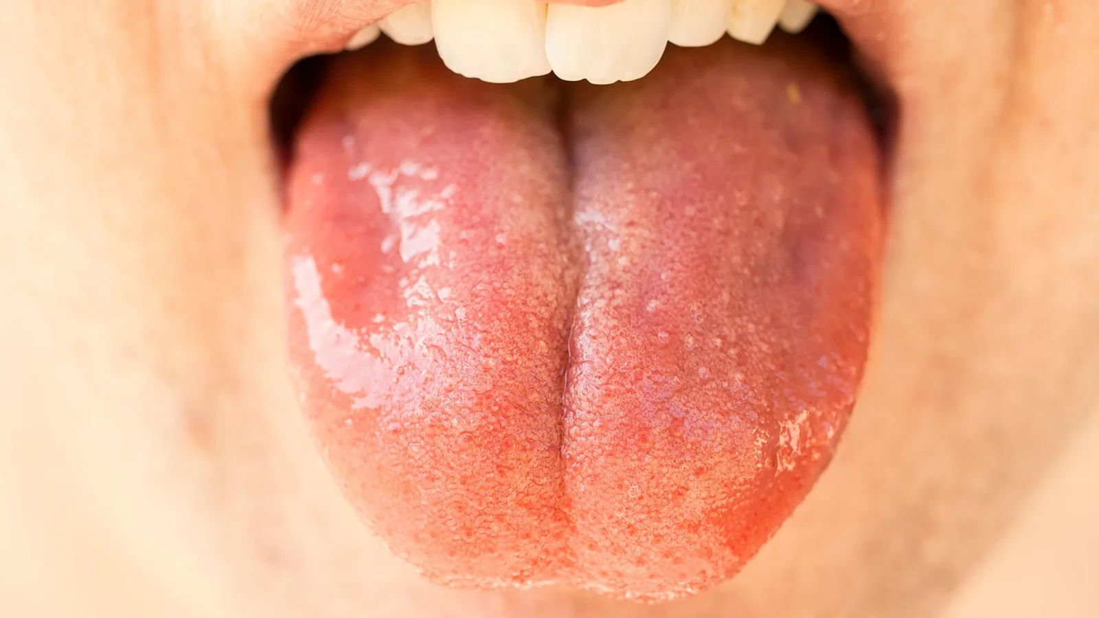 Lingual Tonsils: Anatomy, Location, and Function