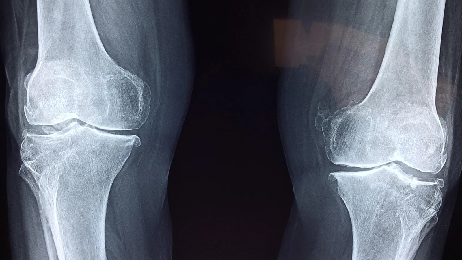 Condyloid Joint: Structure and Movement