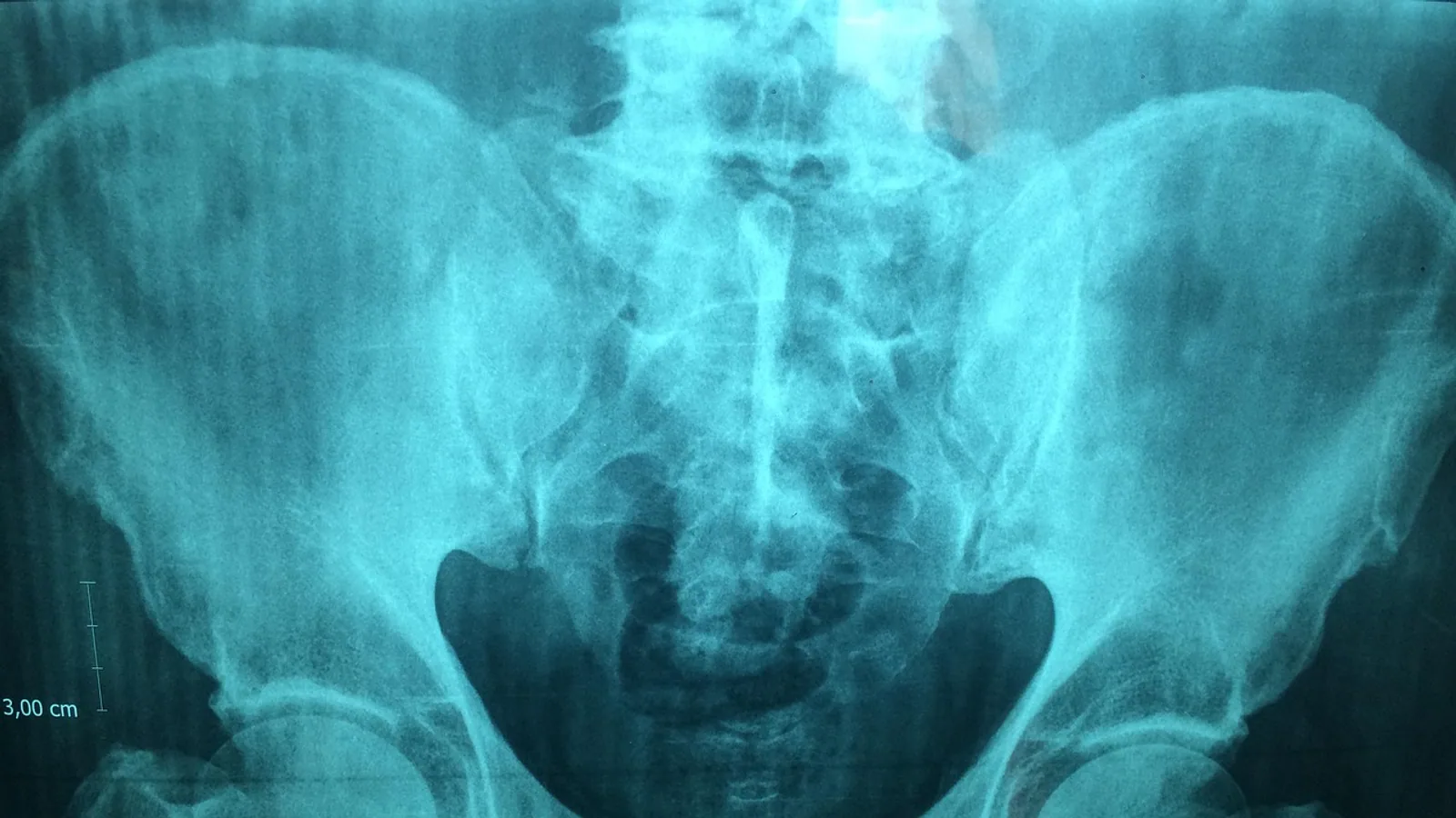 Obturator Foramen: Anatomy, Borders, and Contents