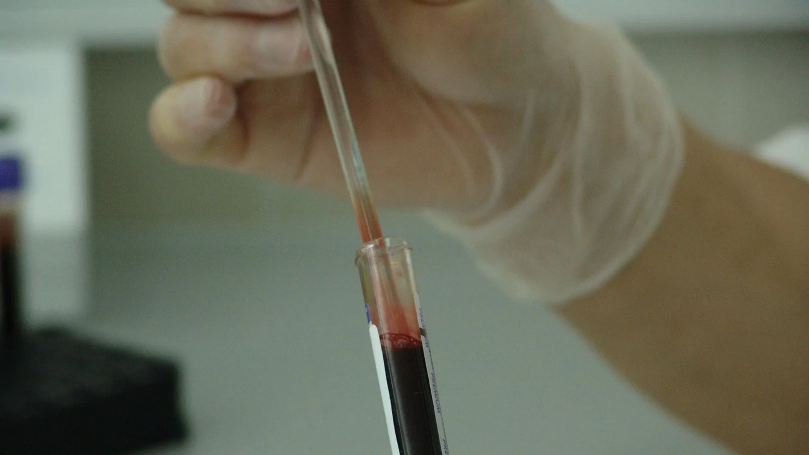 Coombs Test: Direct vs Indirect Antiglobulin Testing